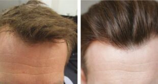Hair Transplant London: What to Expect From Modern Hair Restoration in the UK
