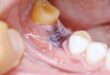 Wisdom Tooth Removal