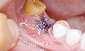 Wisdom Tooth Removal: Everything You Need to Know Before, During, and After the Procedure