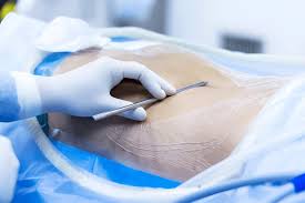 Spine Surgery